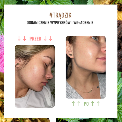 Zestaw BLACK MONTH 3x #trądzik + prezent za 99 zł